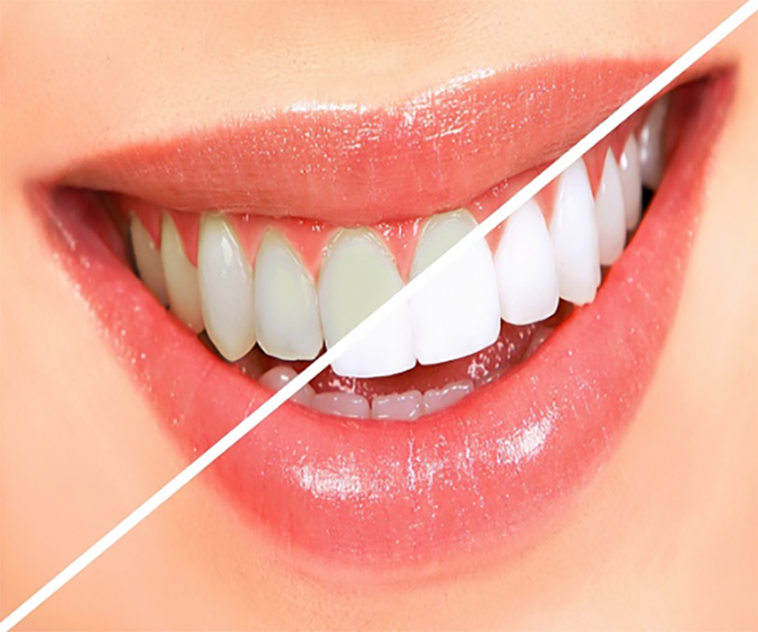 Teeth Whitening near Gangapur Road Nashik